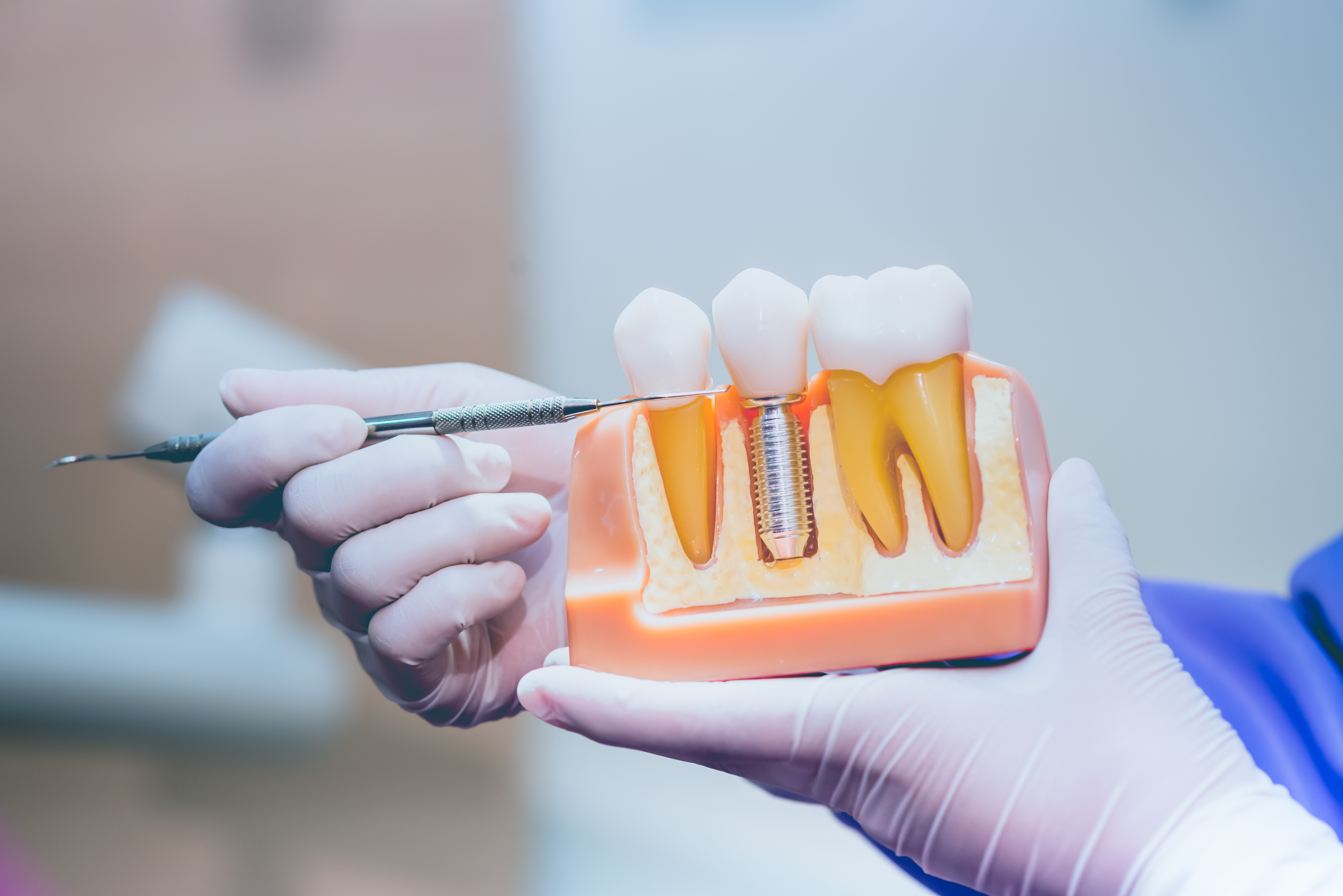 Your Guide to Dental Implants: Everything You Need to Know