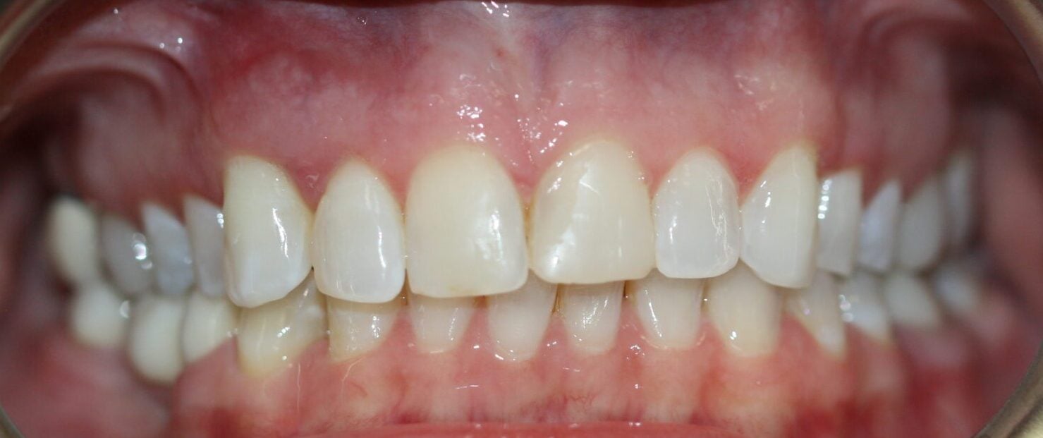 bonnie before
